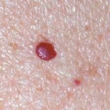 ANGIOMAS CAPILARES Cherry Angioma, Iodine Deficiency, Health Heal, Thyroid Health, Alternative Health, Health Matters, Natural Medicine, Health Info, Warning Signs