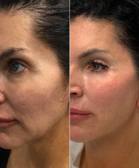 Our lovely patient looks more young  and rested after volume restoration & lower face lift with threads. Way to get natural results nonsurgically Lower Face Lift, Thread Lift Face, Face Plastic Surgery, Face Threading, Derma Facial, Facial Procedure, Cheek Lift, Face Fillers, Face Surgery