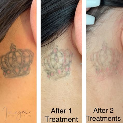 𝗚𝗼𝗶𝗻𝗴, 𝗴𝗼𝗶𝗻𝗴, 𝗚𝗢𝗡𝗘! 😯 Check out these wonderful results achieved with our laser tattoo removal system. Virtually every tattoo removal will require multiple treatments. Most clients need 5 to 10 treatments, while faded tattoos may only need 2 to 4 treatments. During your consultation, our expert laser technician will assess your tattoo and approximate the number of treatments you and your unique tattoo will need. #inya #lasertattooremoval #tattooremoval #canberraskin Laser Tattoo Removal Eyebrows, Tattoo Removal Before And After, Laser Technician, Tattoo Regret, Lazer Removed Tattoo Before And After, Natural Tattoo Removal, Remove Tattoo, Laser Resurfacing Alastin Skincare®, No Regrets Tattoo