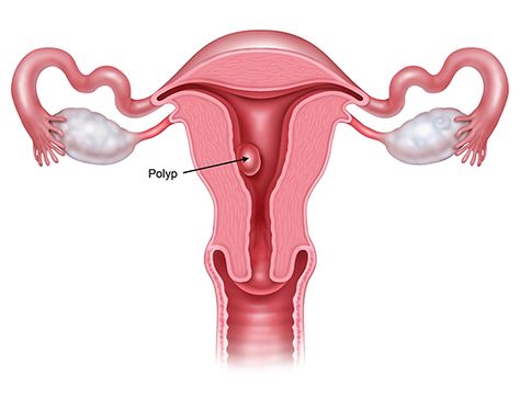 Polyps Uterus, Bicornuate Uterus, Endometrial Polyps, Uterine Polyps, Doctor Office Design, Low Oxalate Diet, Bad Cough, Chronic Cough, Fertility Health