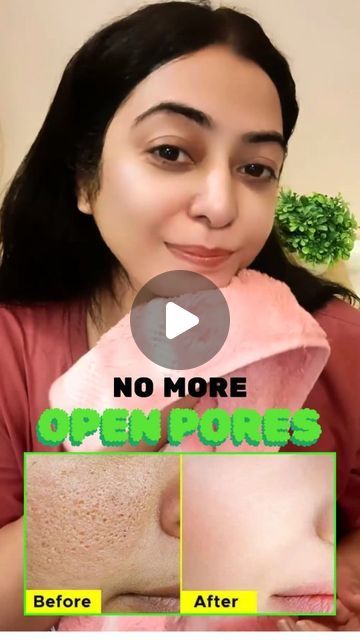 Pooja Luthra | If you want to get rid of open pores large pores, then this remedy is magical for you, it will tighten your pores and will make your skin... | Instagram How To Get Rid Of Pores On Face Natural, How To Remove Pores On Face Naturally, Skin Care For Open Pores, Skin Pores Remedies, How To Remove Pores On Face, How To Remove Open Pores On Face, Open Pores Remedy Natural Treatments, Open Pores On Face How To Get Rid, Pores On Face How To Get Rid Of