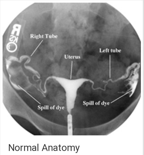 Hysterosalpingography(HSG) or Uterosalpingography Hsg Test, I Refuse To Sink, Radiology Student, Refuse To Sink, Hip Surgery, Fallopian Tubes, Fancy Words, Trying To Get Pregnant, Medical Anatomy