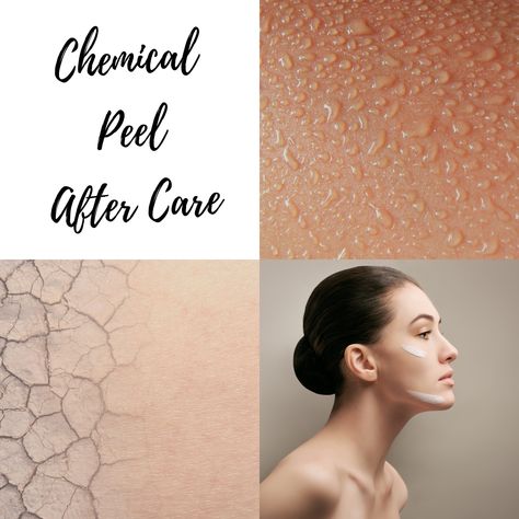 After Chemical Peel Care, Chemical Peel Aftercare, Chemical Peel Benefits, Really Bad Sunburn, Chemical Face Peel, Aesthetics Business, Sunburn Peeling, Bad Sunburn, Natural Face Care