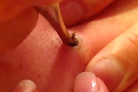 The spine-chilling video is the latest in the spot/blackhead popping craze to go viral across the web Big Zits, Black Heads Removal Video, Ear Pimple, Pimple Extraction, Big Pimple, Cystic Pimple, Blind Pimple, Blackhead Extraction, Pimples Under The Skin