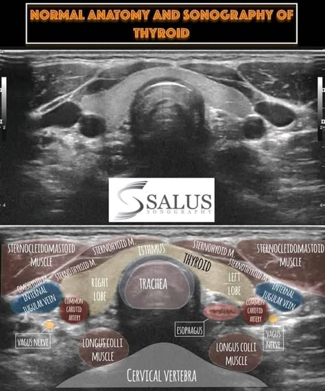 Sonography Humor, Diagnostic Medical Sonography Student, Thyroid Ultrasound, Ultrasound School, Ultrasound Physics, Medical Radiography, Cardiac Sonography, Vascular Ultrasound, Sonography Student