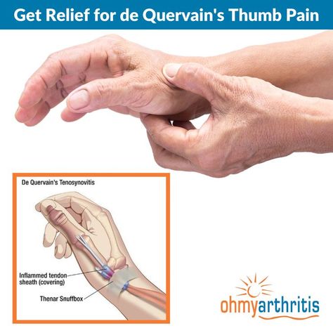 De Quervain's Tenosynovitis, or Mommy's Thumb, is a painful condition caused by inflammation and swelling in the tendons on the thumb side of the wrist and up the side of the forearm. Learn more about this condition and how it can be treated here Thumb Pain Relief, Hand Therapy Exercises, Wrist Pain Relief, K Tape, Thumb Splint, Joints Pain Remedy, Hand Health, Arthritic Pain, Healthy Bodies