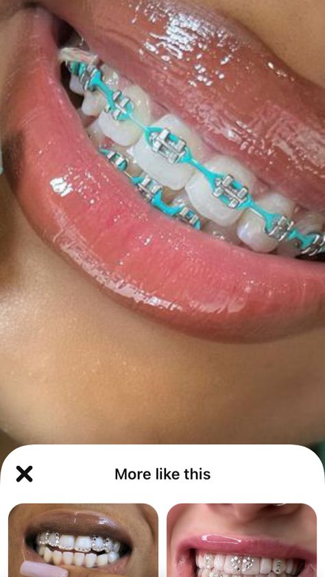 Cute Color For Braces, Braces For Brunettes, Teal Braces For Teeth, Braces Sky Blue, Teal Braces Aesthetic, Bright Braces Colors, Blue Braces Aesthetic, Bottom Braces Only, Teal Power Chain Braces