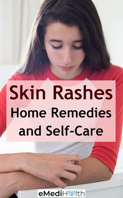 Natural Remedies For Rashes, Skin Allergy Remedies, Natural Rash Remedies, Skin Rash Remedies, Heat Rash Remedy, Home Remedies For Rashes, Rash Remedies, Home Remedies For Face, Itchy Skin Rash