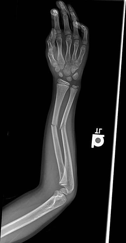 X-rays of Broken Bones | The above x-rays are before the bones were set and the ones below were ... Pictures Of Plants, Arm Bones, Ap Drawing, Broken Arm, X Rays, Banana Milk, Orthopedic Surgery, Broken Leg, Guided Writing