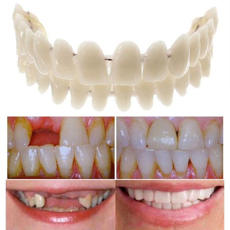 Find many great new & used options and get the best deals for Snap On False Teeth Upper + Lower Dental Veneers Dentures Tooth Cover Set Hot at the best online prices at eBay! Free delivery for many products! Fake Teeth Cosmetic Dentistry, Permanent Dentures, Implants Dental, Picture Perfect Smile, Teeth Covers, Temporary Tooth, Tooth Repair, Veneers Teeth, Supportive Sandals