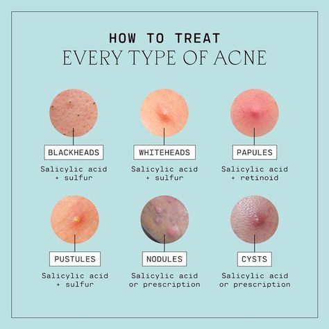 From blackheads to cysts, breakouts happen to pretty much everyone.🗣️ Say it with us: Acne is normal! Here's a handy guide on how to treat every type of acne. Save this for later and click to read The Good Skin Blog for a detailed breakout down. Skin Facts, Popular Skin Care Products, Skin Advice, Natural Face Skin Care, Natural Acne Remedies, Types Of Acne, Basic Skin Care Routine, Skin Care Tutorial, Acne Scar Removal