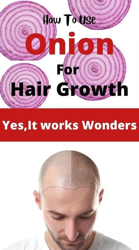 Onion Hair Growth, Hair Growth Pills, Quick Hair Growth, Accelerate Hair Growth, Healthy Natural Hair Growth, Hair Growth Foods, Onion For Hair, How To Grow Your Hair Faster, Growth Hair