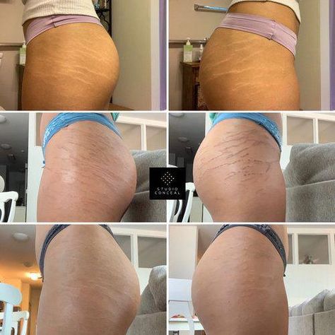 How To Remove Stretchmarks Naturally, Natural Stretch Mark Remedies, Best Stretch Mark Removal, Pregnancy Stretch Mark Routine, How To Prevent Pregnancy Stretchmarks, Abdominal Stretches, Strech Marks, Best Peel Off Mask, Scalp Micropigmentation