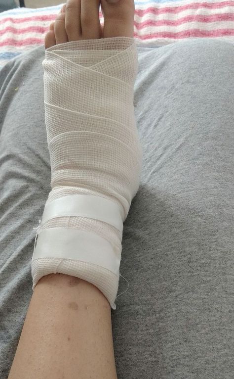 Leg Fracture Snapchat Story, Leg Injury In The Hospital, Leg Fracture Photos, Fractured Leg Broken Foot, Leg Plaster Snapchat, Injured Leg Snap, Leg Fracture Snap, Leg Fracture Snapchat, Sprained Ankle Snapchat