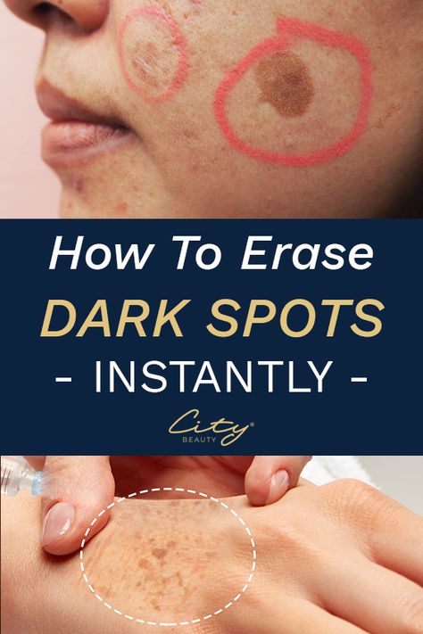 Here's a Great Solution Recommended by Beauty Experts to clear up dark spots, age spots & sun spots. How To Fade, Dark Spots On Face, Brown Spots Removal, Dark Spots On Skin, Dark Spot Corrector, Fade Dark Spots, Skin Care Wrinkles, Spots On Face, Baking Soda Shampoo