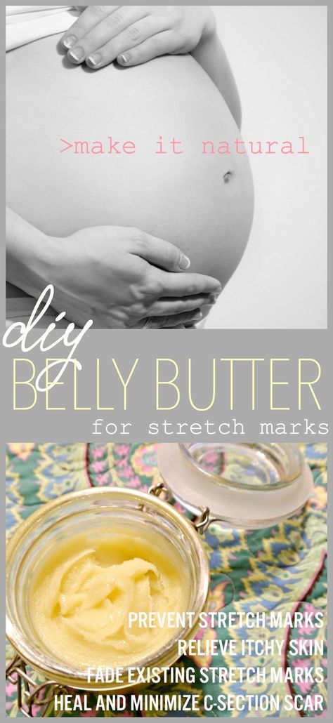 Body Butter For Pregnant Women, Doterra Stretch Mark Blend, Homemade Stretch Mark Cream, Belly Butter Pregnancy Diy, Diy Stretch Mark Oil, Diy Belly Butter, Stretch Mark Cream Pregnancy, Stretch Mark Prevention, Stretch Mark Oil