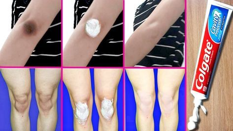 How to Get Rid of Dark Knees and Elbows with Toothpaste | Whiten Dark El... How To Lighten Knees, Lighten Dark Knees, Dark Knees And Elbows, Skin Lightening Diy, Dark Knees, Dark Elbows, Colgate Toothpaste, Dark Underarms, Beauty Tips For Glowing Skin