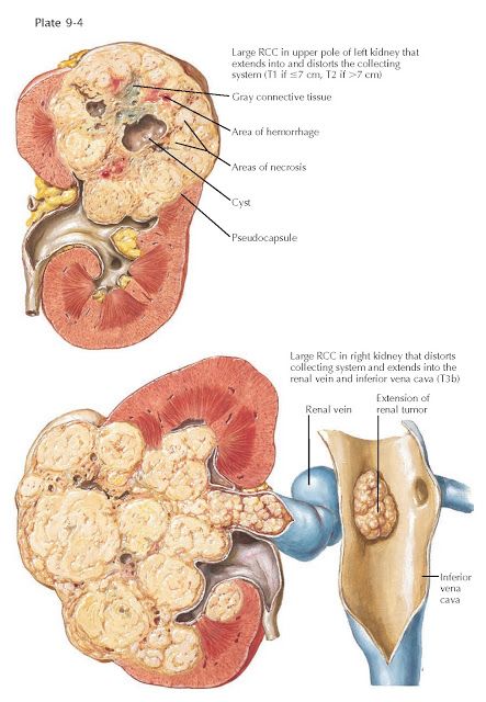 GROSS PATHOLOGIC FINDINGS IN RENAL CELL CARCINOMA Kidney Tumor, Renal Cell Carcinoma, Creatinine Levels, Musculoskeletal Pain, Medical School Essentials, Adrenal Glands, Pelvic Pain, Bacterial Infection, Healthy Tips