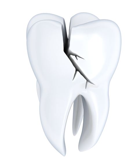 For a cracked tooth, immediately rinse the mouth with warm water to clean the area. Put cold compresses on the face to keep any swelling down. See your #dentist as soon as possible. Bad Hairline, Teeth Images, Cracked Tooth, Dental Emergency, Emergency Dentist, Pediatric Dentist, Jaw Bone, Dental Problems, Dental Implants