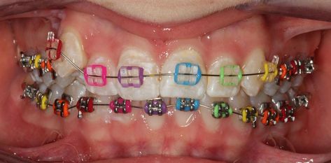 Cute Colors For Braces, Braces Power Chain, Rainbow Braces, Power Chain Braces, Braces Color Wheel, Power Chain, Cute Braces Colors, Braces Girls, Health Aesthetic