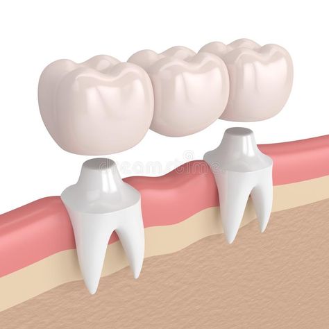 Denture Repair Kits, Tooth Bridge, Dental Bridge Cost, Denture Repairs, Tooth Crown, Dental Images, Dental Insurance Plans, Dental Exam, Missing Teeth