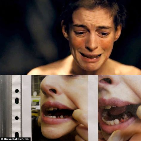 Anne Hathaway won Best Supporting Actress for her role as Fantine in Les Miserables. To play the role, she had to lose weight and even cut her hair, but fortunately the missing teeth was accomplished by painting over her existing teeth. In an interview she said, "I would have pulled out my teeth to play Fantine." Les Miserable, Losing Teeth, Les Miserables 2012, Missing Teeth, Cut Her Hair, Anne Hathaway, Les Miserables, The Missing, She Said