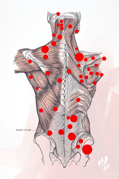 Back Trigger Points. These are common areas where people develop "knots" or hard spots where #muscles get stuck together. By applying pressure and rubbing on these #knots, back and neck muscles can be released and therefore pain is reduced. #TriggerPoint #TriggerPoints  #massage #MassageTherapy Punkty Spustowe, Autogenic Training, Muscle Knots, Massage Therapy Techniques, Trigger Point Therapy, Reflexology Massage, Trigger Point, Shiatsu Massage, Massage Benefits