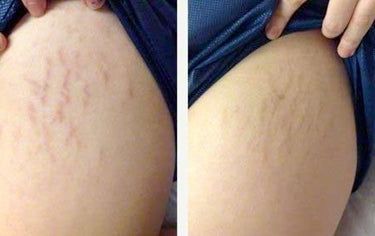 Unlock Stretch Mark Skincare Secrets! 🥰️ stretch mark underarm, stretch marks lotions, what to use for stretch mark #healthyskin #wellness #skincare Marks Cream, Pregnancy Weight Gain, Skin Marks, Skincare Secrets, Best Lotion, Stretch Mark Removal, Stretch Mark Cream, Stretch Mark, Itchy Skin