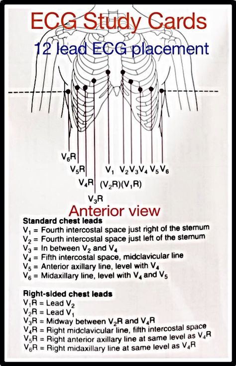 12lead placement Lvn Notes, 12 Lead Ekg Placement, Ecg Placement, Ekg Placement, Telemetry Technician, Cardiovascular Nursing, Telemetry Nursing, Cardiac Sonography, Cardiology Nursing