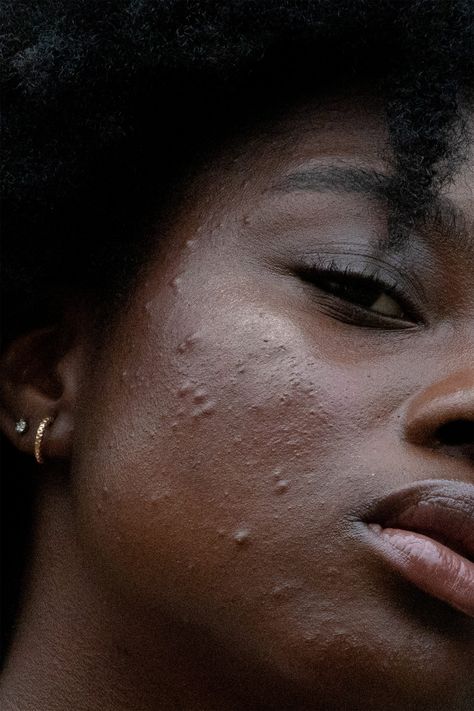 How To Approach Acne, Hyperpigmentation & Sun Damage, According To A Beauty Expert null Acne Hyperpigmentation, Forehead Acne, Skin Needling, Uneven Skin Texture, Sun Damaged Skin, Beauty Vitamins, Acne Spots, Effective Skin Care Products, Improve Skin Texture