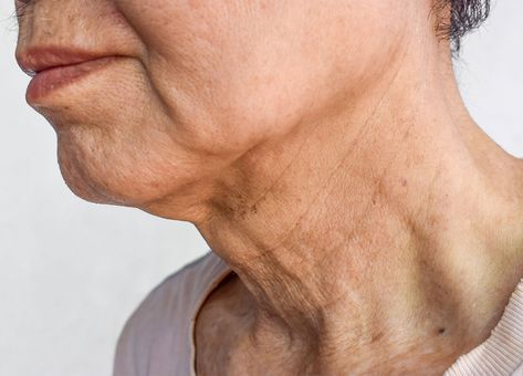 A Derm Reveals How To Reverse An Aging, Wrinkled Neck And Minimize Horizontal Neck Lines To Appear Decades Younger Contour Hacks, Creepy Skin, Eyeliner Techniques, Face Tightening, Neck Lines, Hair To One Side, Neck Wrinkles, How To Get Rid Of Pimples, Professional Hairstylist