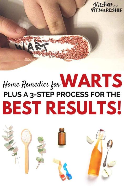 Home remedies for warts that are simple, natural, and cost-effective. Plus the three-step process that gets the best results! Remove warts naturally with these simple techniques put to the test by a real family. Home Remedy For Warts, Filiform Wart, Natural Wart Remedies, Warts On Face, Home Remedies For Warts, Warts Remedy, Natural Remedies For Migraines, Allergy Remedies, Get Rid Of Warts