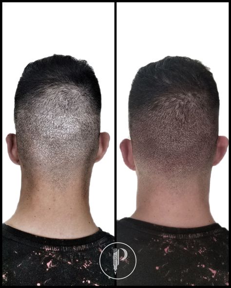 Hair Surgery, Micro Pigmentation, Scalp Micropigmentation, Home Remedies For Hair, Undercut Hairstyles, Hair Transplant, Permanent Makeup, Undercut, Makeup Hair