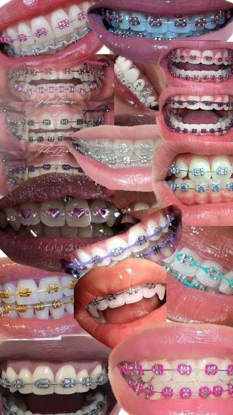 Perfect Teeth Braces, Braces Colors Combinations, Braces Colours, Braces Ideas, Cute Braces Colors, Hello Kitty Nails Art, Pretty Teeth, Braces Tips, Getting Braces