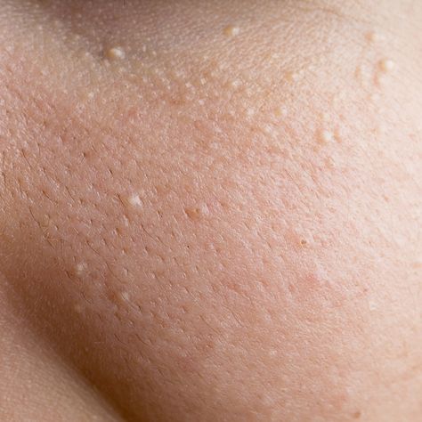 The Ultimate Guide to Bumps or Splotches on Your Face White Bumps On Face, Small Bumps On Face, Holistic Skincare, Remove Skin Tags Naturally, Blind Pimple, Pimples Under The Skin, Skin Bumps, Mole Removal, How To Get Rid Of Pimples