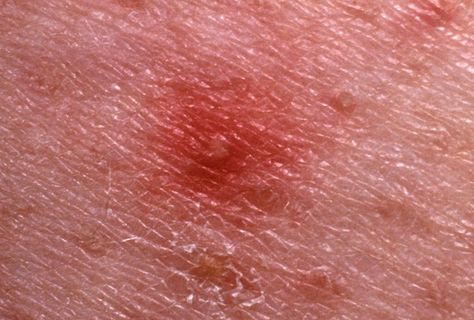 It might be tempting, but it’s best not to pick at these types of blemishes Red Spots On Legs, Red Spots On Face, Bumps On Legs, Red Skin Spots, Infected Ingrown Hair, Facial Veins, Hair On Face, Bumps On Skin, Spots On Legs