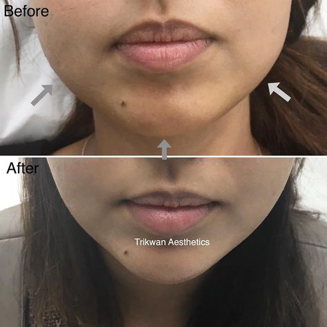 Alteration of jawline from square to v-shape using chin fillers.  #jawline #jawlineslimming #slimming #vshapedface #botox #chinfiller #filler #masseter #masseterbotox #bruxism #teethgrinding #slimface #dermalfillers #juvederm #chin #london #aesthetics #trikwan #trikwanaesthetics #drdiwan #dr #doctor #instadoc #cosmetic #transformation L Shaped Jawline Aesthetic, V Line Surgery Before And After, V Chin Aesthetic, Cheek And Jaw Fillers, Masseter Botox Before And After, Before And After Jaw Filler, Chin Jaw Cheek Filler, Jaw And Cheek Filler, V Shape Face