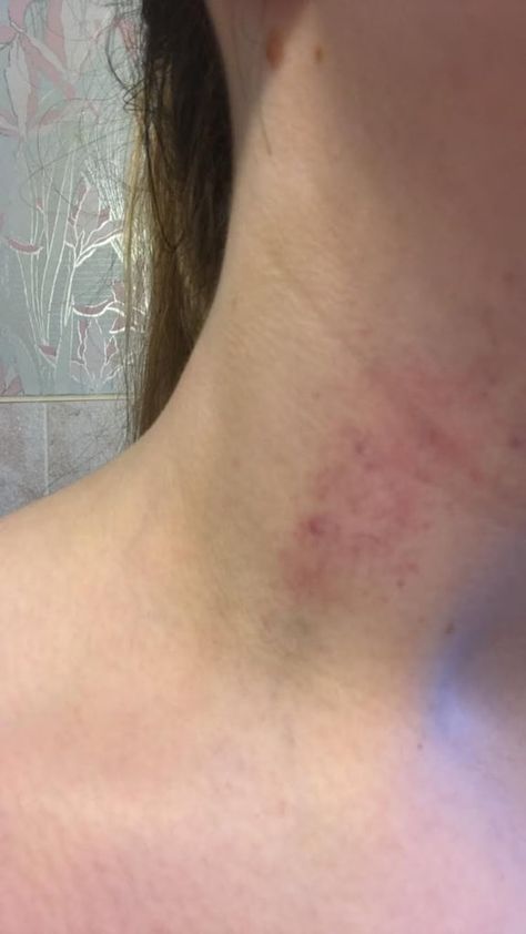 Before Love Bites Dpz, Love Bite Photos Aesthetic, Love Bite Photos Real, Love Bite Snap, Love Bites Hickey, Neck Full Of Hickeys, Love Bite Photos, Burned Hand Pic, Hickies Neck