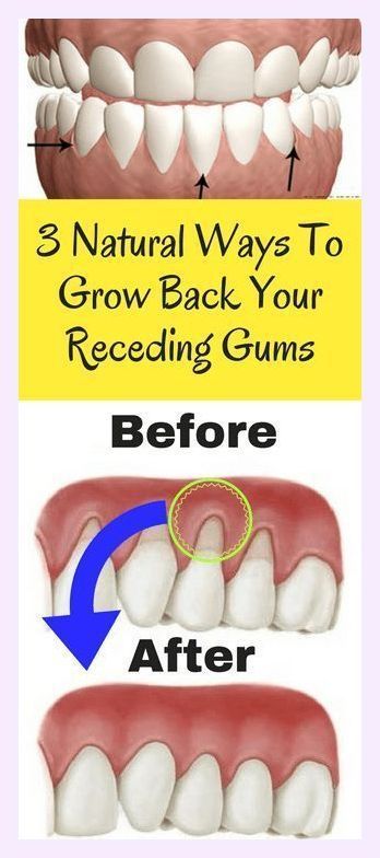 Grow Back Your Receding Gums With The Help Of These Natural Remedies Grow Back Receding Gums, Reverse Cavities, Tooth Sensitivity, Gum Care, Oral Care Routine, Receding Gums, Gum Health, Teeth Care, Oral Health Care