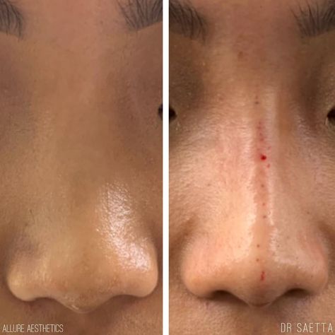 Nose Filler, Nose Surgery Rhinoplasty, Mini Face Lift, Nose Fillers, Bulbous Nose, Esthetician Inspiration, Facial Procedure, Rhinoplasty Nose Jobs, Rhinoplasty Surgery