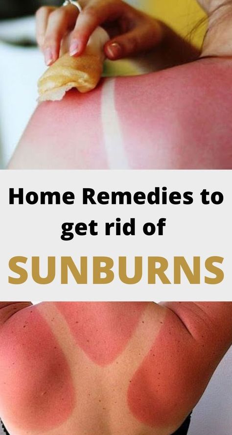 Diy Sunburn Remedies, Bad Sunburn Remedies, Quick Sunburn Remedies, How To Get Rid Of A Sunburn Fast, How To Heal Sunburn Fast, Sun Burn Remedy, Heal Sunburn Fast, Sunburn On Face, Sunburn Blisters