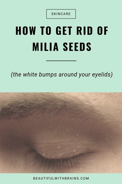 What the heck are those tiny those white bumps around your eyes?!They’re white, but they’re not whiteheads. They’re too small to be pimples. And it doesn’t look like your skin is irritated either… What’s going on?Milia seeds. Or white bumps on your eyelids, as we all like to call them. They’re common but super hard to treat. Here's how to prevent them... #miliaseeds #skincare Blind Pimple, Diy Wrinkles, Pimples Under The Skin, How To Get Rid Of Pimples, Forehead Wrinkles, Skin Care Wrinkles, Face Wrinkles, Body Hair Removal, Unwanted Hair Removal