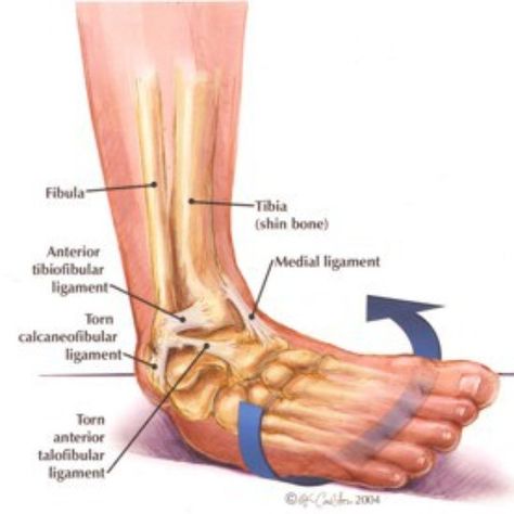 FRIDAY FOCUS - Spraining/tearing the lateral ligaments of the ankle (i.e. going over on the outside of your ankle) are among the most common injuries that people experience during sports. The most commonly injured ligament on the outside of the ankle is referred to as the anterior talofibular ligamental (ATFL) which is one of 3 main lateral ligaments. The ankle joint moves in many ways. During movement there is a degree of rolling and sliding that occurs. Ligaments on the outside of the ankl... Ankle Anatomy, Ankle Ligaments, Twisted Ankle, Ligament Tear, Ankle Pain, Muscle Anatomy, Ankle Injury, Human Anatomy And Physiology, Sprained Ankle