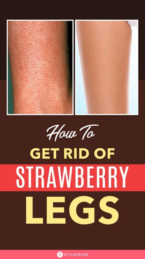 How To Get Rid Of Strawberry Legs – 3 Simple Steps To Soft And Beautiful Legs #BeautyTips #SkinCare #StrawberryLegs #Tips #Tricks Back Hair Removal, Camouflage Makeup, Strawberry Legs, Underarm Hair Removal, Unwanted Facial Hair, Hair Removal Methods, Facial Hair Removal, Hair Removal Permanent, Body Hair Removal