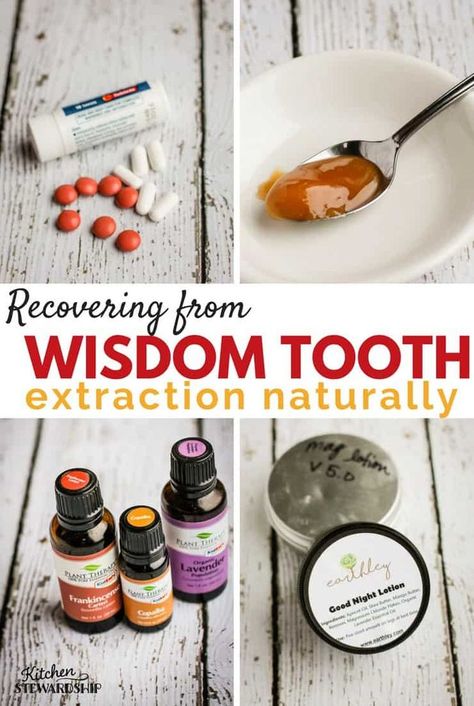 I got 3 wisdom teeth removed without general anesthesia! Here are all my tips for natural pain relief for wisdom teeth removal recovery with no pain killers. #naturalhealth #wisdomteeth #dentist #homeopathy Wisdom Teeth Recovery Food, Getting Wisdom Teeth Out, Wisdom Teeth Removal Recovery, Wisdom Teeth Food, Wisdom Teeth Pain Relief, Wisdom Teeth Recovery, Tooth Pain Remedies, Wisdom Teeth Pain, Tooth Pain Relief