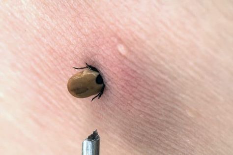 How to Identify Tick Bites | IGeneX Tick Talk Tick Bites Pictures, Ticks On Humans, Types Of Ticks, Rash Causes, Tick Spray, Deer Ticks, Tick Removal, Tick Bite, Pimples Remedies