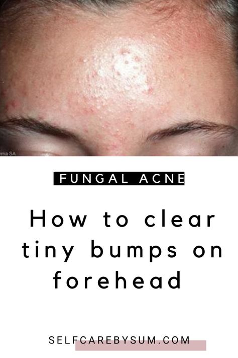 Learn  with these natural remedies and home remedies. #foreheadbumps #bumpsonforehead #howtogetridofforeheadbumps #naturalremedies Tiny Bumps On Forehead, Forehead Pimples, Nizoral Shampoo, Small Bumps On Face, Forehead Bumps, Head Acne, Spots On Forehead, Pimples On Forehead, Fungal Acne