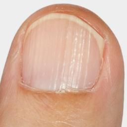 Toe Nail Fungal Infection Ridges On Toenails, Horizontal Nail Ridges, Fingernail Ridges, Nail Symptoms, Nail Ridges, Nail Infection, Fungal Nail, Nails Today, Damaged Nails