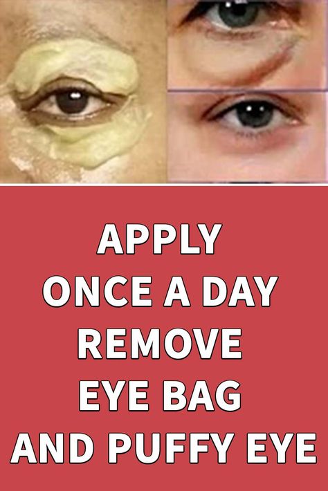 Eye Bag Remedies, Puffy Eyes Remedy, Wrinkles Remedies Face, Puffy Eye, Remove Eye Bags, Eye Skin Care, Natural Face Skin Care, Skin Care Wrinkles, Eye Wrinkle