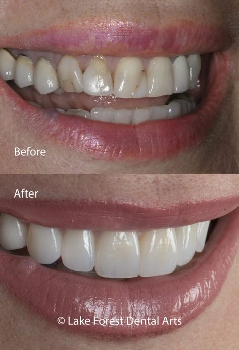 Zirconia crowns before and after Cosmetic Dentistry Before And After, Teeth Veneers Before And After, Dental Veneers Before And After, Veneers Before And After, Teeth Makeover, Cosmetic Dentistry Veneers, Veneers Teeth, Aesthetic Dentistry, Beautiful Teeth